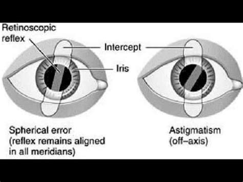 Retinoscopy Of The Eye Ophthalmology Youtube Optometry Opthalmic