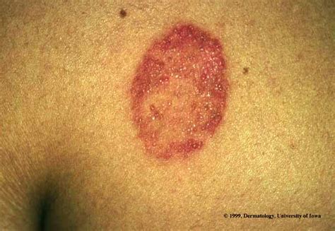 Ringworm Picture From Ui Dermatology Tinea Corporis Hardin Md
