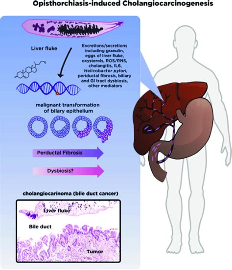 Schematic Representation Of Cancer Of The Biliary Tract Induced By
