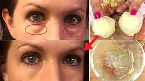 In 3 Days Remove Under Eye Bags Completely Remove Dark Circle
