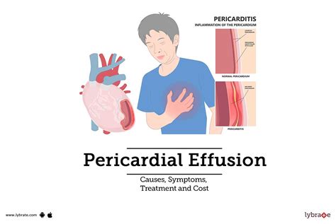 Pericardial Effusion Causes Symptoms Treatment And Cost