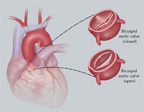 Heart Valve Disease And What We Need To Know About It