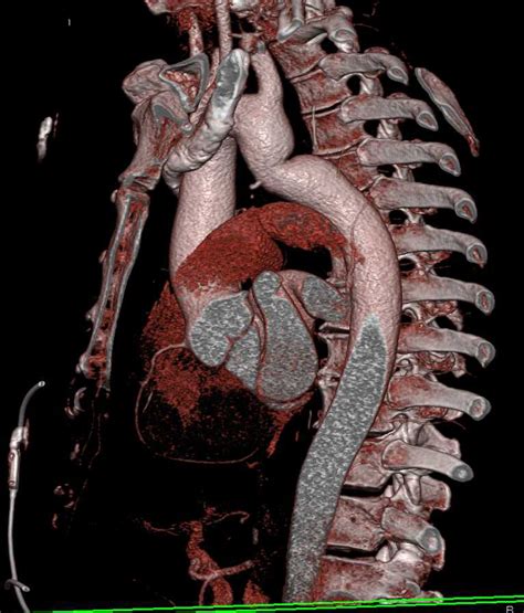 Prior Repair Of Coarctation Of The Aorta Cardiac Case Studies