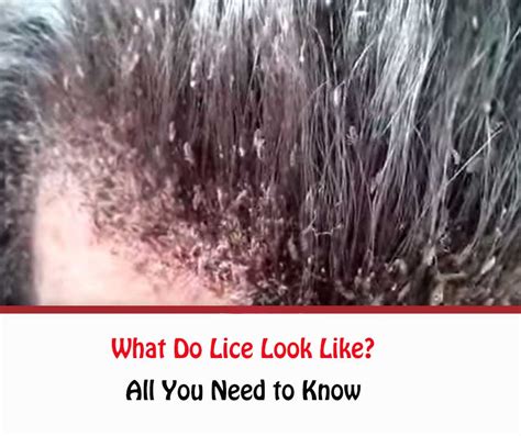 Em Geral 90 Imagen What Do Lice Look Like In Blonde Hair Alta