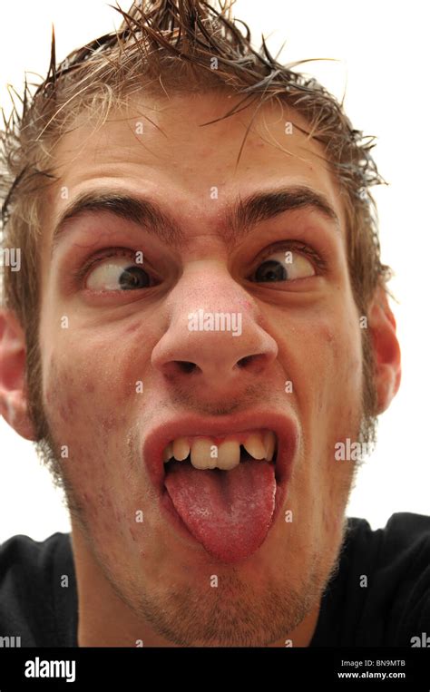 Crazy Wacky Ugly Man With Crooked Teeth And Acne And Veins Above His