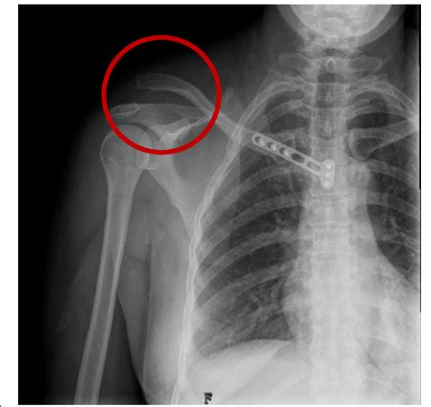 A Postoperative X Ray Showing Right Acromioclavicular Joint Dislocation