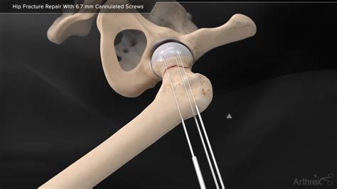 Arthrex Hip Fracture Repair With 67 Mm Cannulated Screws