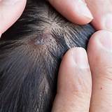Psoriasis On Your Scalp Treatment Pictures