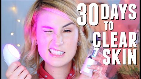 How I Cleared My Acne In A Month With Before And Afters Youtube