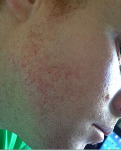 Red Marks On Cheeks Please Help Pictures Hyperpigmentation Red