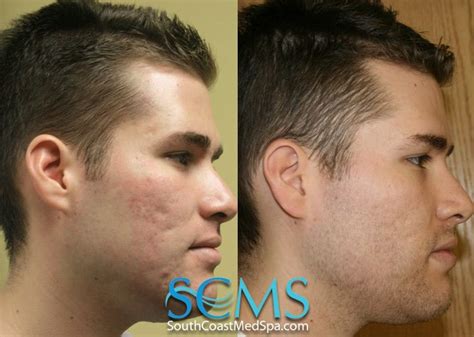 Laser Skin Resurfacing Before And After La San Diego Acne Scar Cure