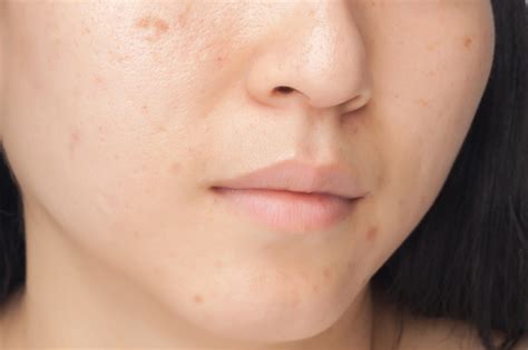 How To Remove Brown Spots Dr Joan Hardt Okc