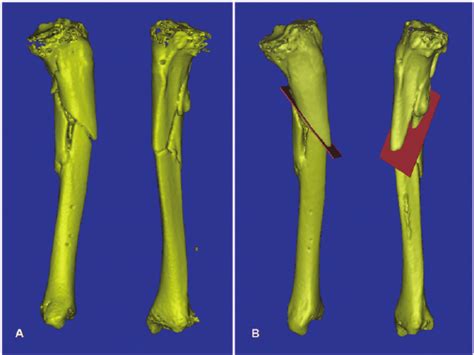 For Patient 2 A 3d Model Of The Left Tibial Fracture Non Union With