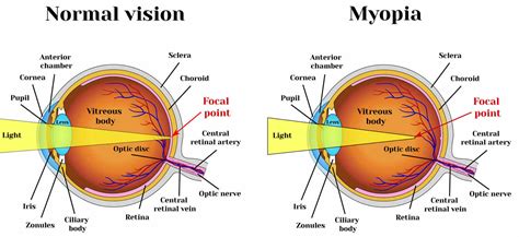 Myopia Nearsighted Vision Causes Signs Symptoms Treatment