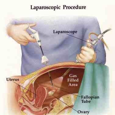 Sinaii n, plumb k, cotton l et al. Endometriosis y Laparoscopia | SaludAIO