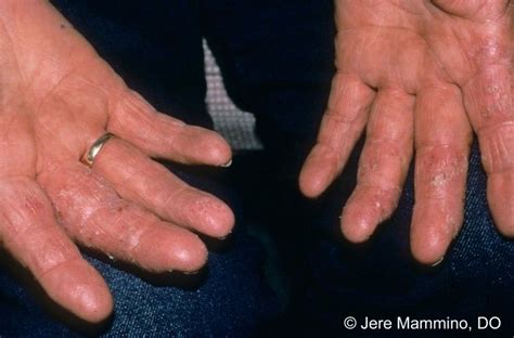 Hand Rashes Rash On Hands Rashes Dermatology The Best Porn Website