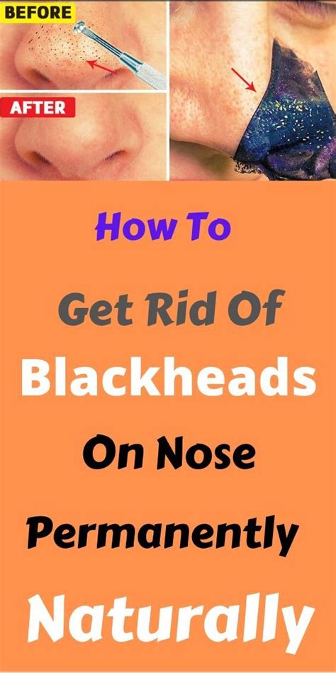 How To Get Rid Of Blackheads On Nose Permanently Naturally ...