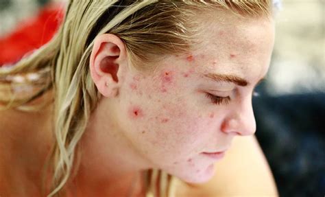 Habits Of Skin Care That Can Adequately Worsen Acne Hospitalninojesus