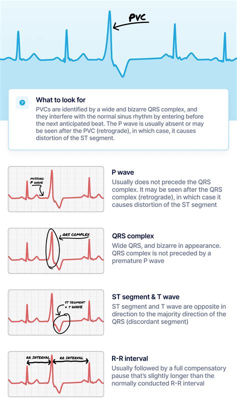 what premature ventricular contraction pvc looks like on your watch ecg qaly