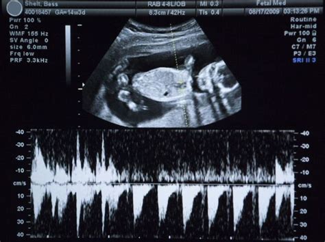 How To Read Baby Heartbeat On Ultrasound Ababyw