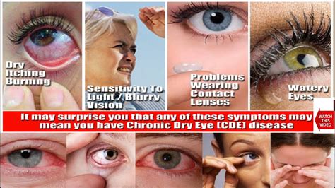 Dry Eye Syndrome Patient Education And Information Causes Symptoms