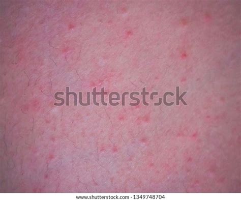 Skin Itching Rashred Spots On Skinred Stock Photo 1349748704 Shutterstock