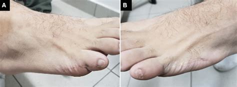 Evidence Of Post Axial Polydactyly Surgery A Right Foot Surgical Download Scientific