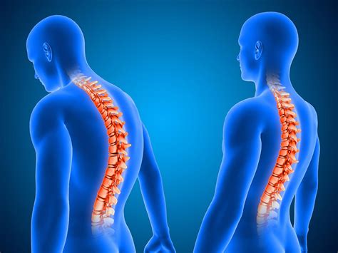 Scheuermanns Disease Treatment In Fairfax Va Sapna Spine And Pain