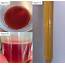 Reddish Urine Observed During Exacerbation1ab Normal Color 