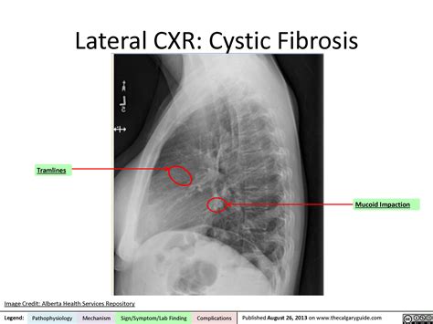 Lateral Chest X Ray Calgary Guide