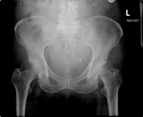 The Pelvis and Hip