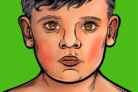 How To Identify Common Childhood Rashes The New York Times