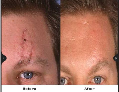 Dr Freemans Scar Revision Before And After Photo Scar Facial