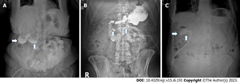 Role Of Contrast Enhanced Serialspot Abdominal X Rays In Perioperative
