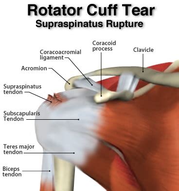 Supraspinatus Tear Ohio Therapy Centers Northeast Ohio