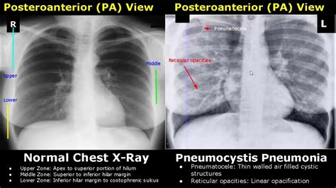 Chest X Ray Lung Normal Vs Abnormal Image Appearances Part 1 Tb