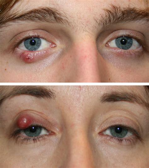 Eyelid Cysts Eyelid Surgery Centre Eyelid And Midface Specialist