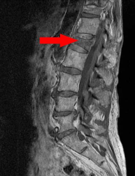 Vertebral Compression Fractures - Symptoms, Complications ...