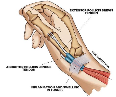 Dequervains Tenosynovitis Hand Wrist Surgeon Perth