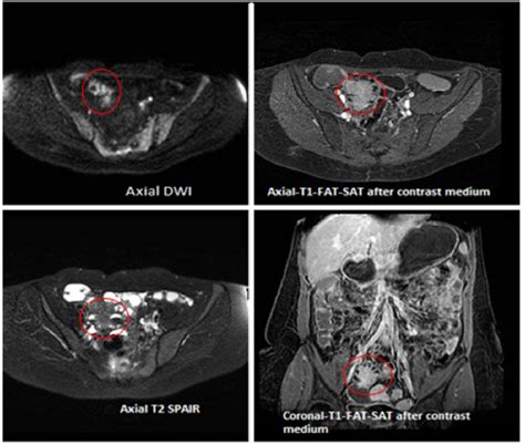 Figure 1 From Role Of Imaging In The Preoperative Assessment Of Pelvic