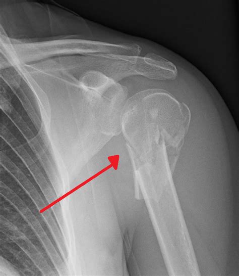 What Are Proximal Humerus Fractures Orthopedic Implants For Tendons