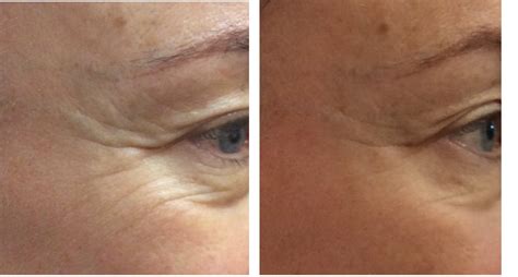 Cheshire Lasers Ultraformer Wrinkle Treatment Before And Afters