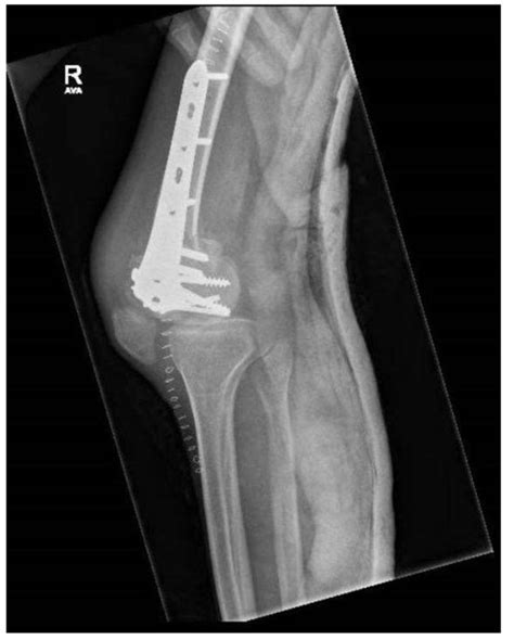 Intramedullary Nail Femur Icd 10 - Nail Ftempo