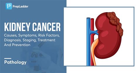 Kidney Cancer Causes Symptoms Risk Factors Diagnosis Staging