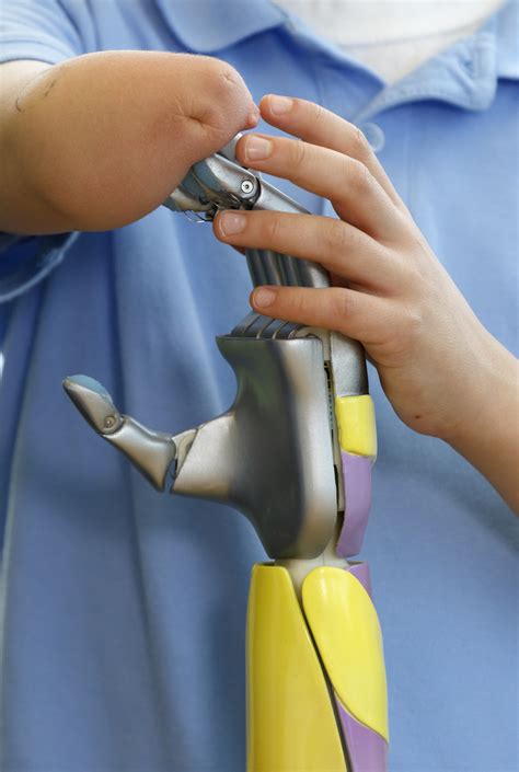 Ohsu Ucf Launch First Us Clinical Trial Of 3d Printed Prosthetics