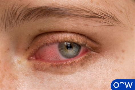 Shingles In The Eye Symptoms Complications And More