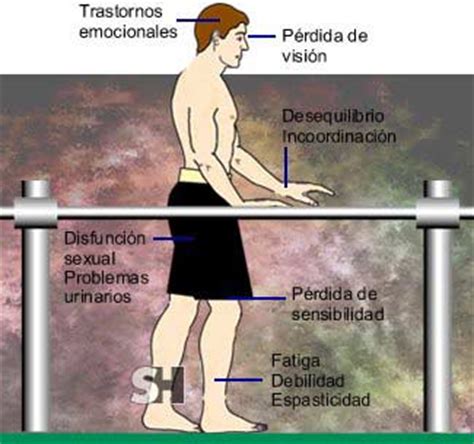Jul 28, 2021 · medlineplus en español contiene enlaces a documentos con información de salud de los institutos nacionales de la salud y otras agencias del gobierno federal de los ee. Esclerosis Múltiple - Fisioterapia Neurológica