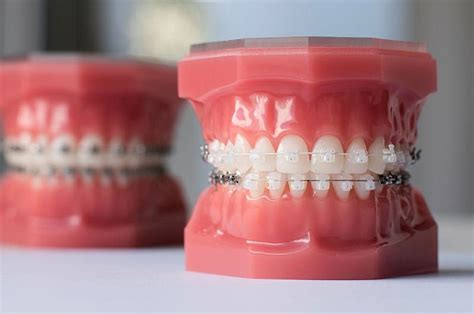can braces fix crooked teeth southern delaware dental specialists