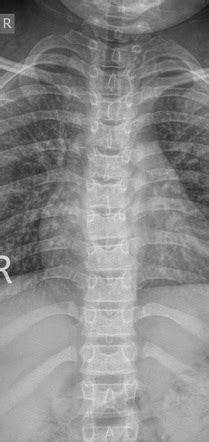 Normal Thoracic Spine X Ray Year Old Image Radiopaedia Org