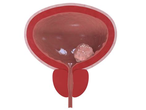 Check spelling or type a new query. Bladder Cancer | Oxford Urology Associates